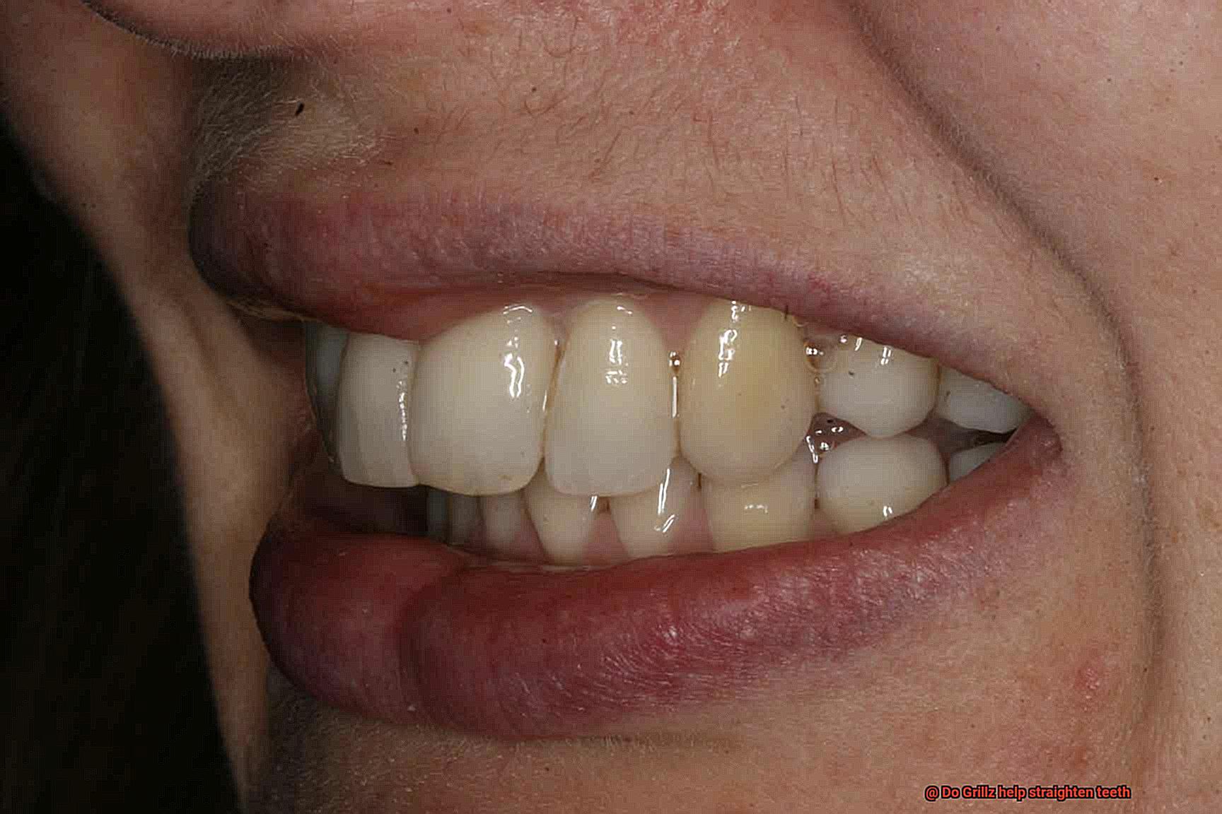 Do Grillz help straighten teeth-6